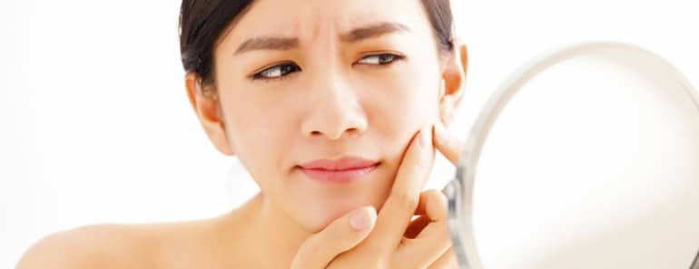 Tratamiento acne con láser