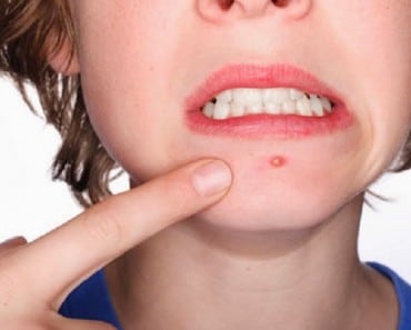 5 remedios naturales para deshacerse del acné de una vez por todas