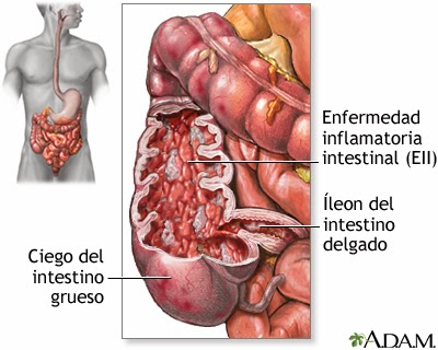 ¿Qué es la colitis ulcerosa? ¿Qué es la colitis ulcerosa?