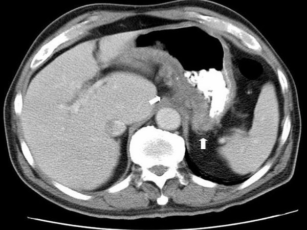 ¿Cómo saber si tengo la enfermedad de Crohn? ¿Cómo saber si tengo la enfermedad de Crohn?