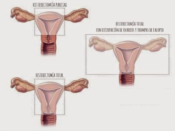 ¿Qué es una histerectomía?