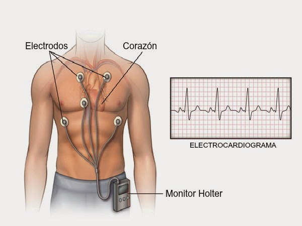 ¿Para qué sirve un monitor Holter?