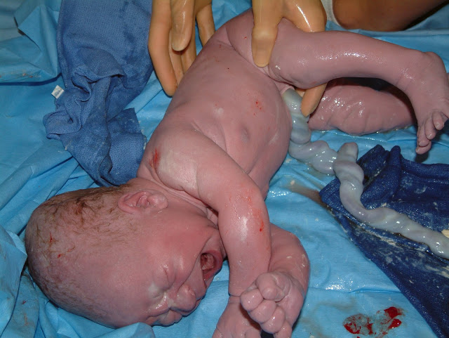 Infección de cordón umbilical y muerte neonatal