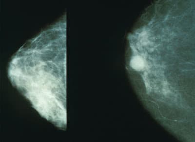 Beneficios de la mamografía