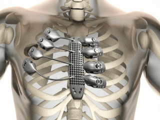 prótesis del esternón y de las costillas 3D
