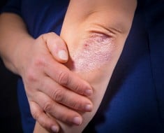 Cosas que deberías saber sobre la psoriasis
