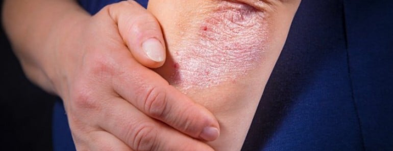 Cosas que deberías saber sobre la psoriasis