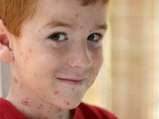 Atopichesky la dermatitis con la enfermedad zhkt