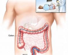 Colonoscopia y cáncer de colon