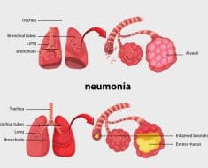Qué es la neumonía
