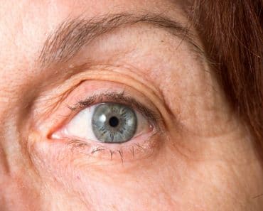 ¿Sabes qué es el síndrome del ojo seco?