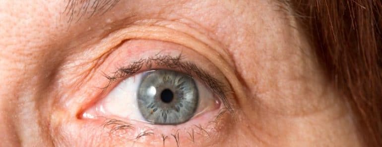 ¿Sabes qué es el síndrome del ojo seco?
