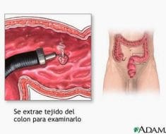 Qué son los pólipos intestinales