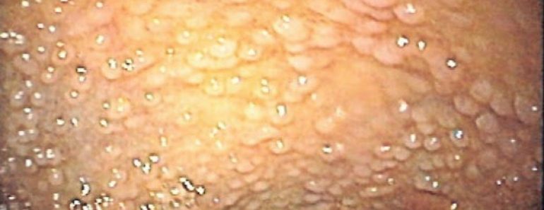 Poliposis adenomatosa familiar