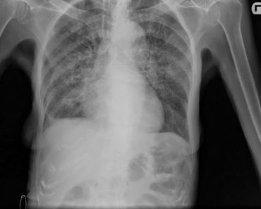 Cáncer de colon con metástasis pulmonar