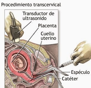 Biopsia transcervical de vellosidades coriónicas