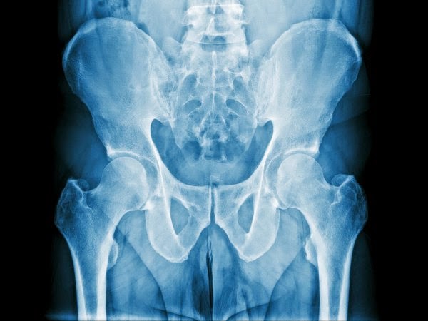 Cancer prostata y huesos