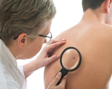 Melanoma: ¿por qué están aumentando entre los más jóvenes?