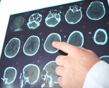 Epilepsia: Claves para conocerla