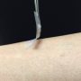 Inventan un parche para controlar la diabetes sin tener que pincharse