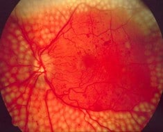 Google prueba con éxito su tecnología de IA para diagnosticar la retinopatía diabética