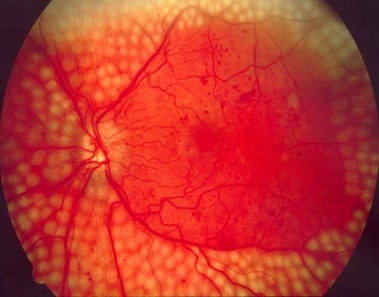 Google prueba con éxito su tecnología de IA para diagnosticar la retinopatía diabética