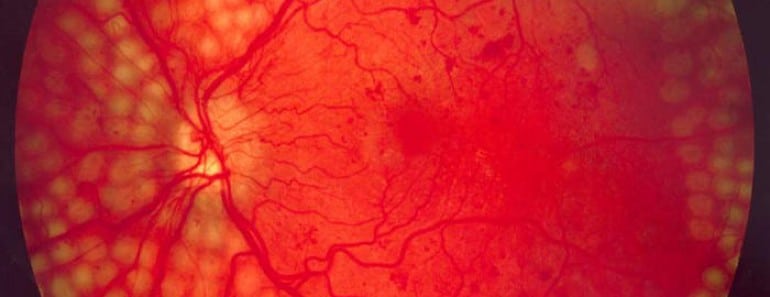 Google prueba con éxito su tecnología de IA para diagnosticar la retinopatía diabética