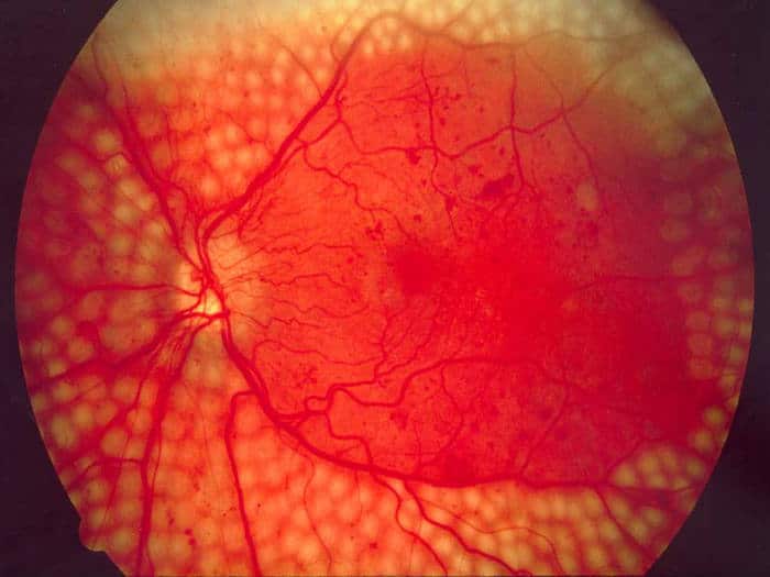 Google prueba con éxito su tecnología de IA para diagnosticar la retinopatía diabética