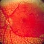 Google prueba con éxito su tecnología de IA para diagnosticar la retinopatía diabética