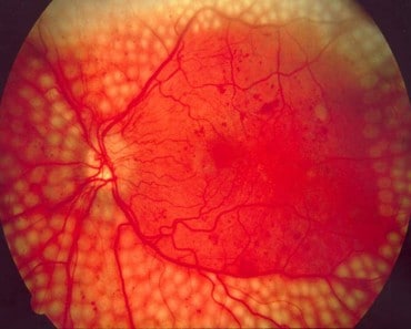 Google prueba con éxito su tecnología de IA para diagnosticar la retinopatía diabética